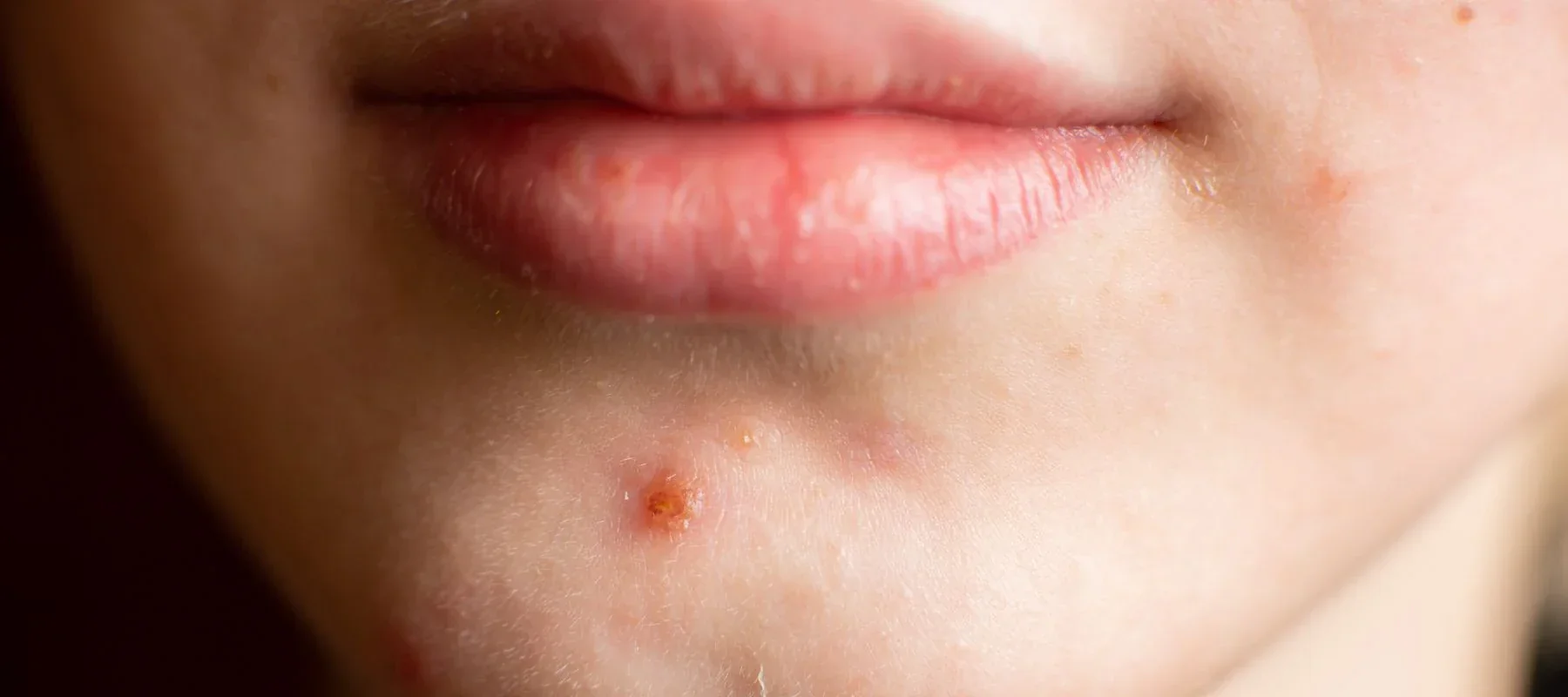 Do you have a pimple on your face?