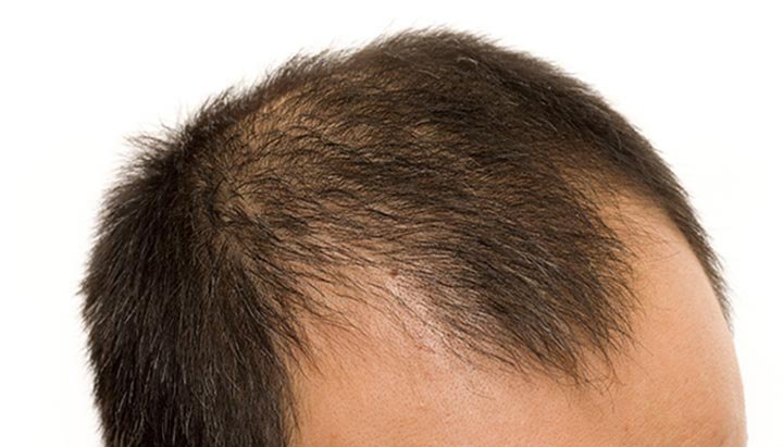 Do you know what causes hair loss