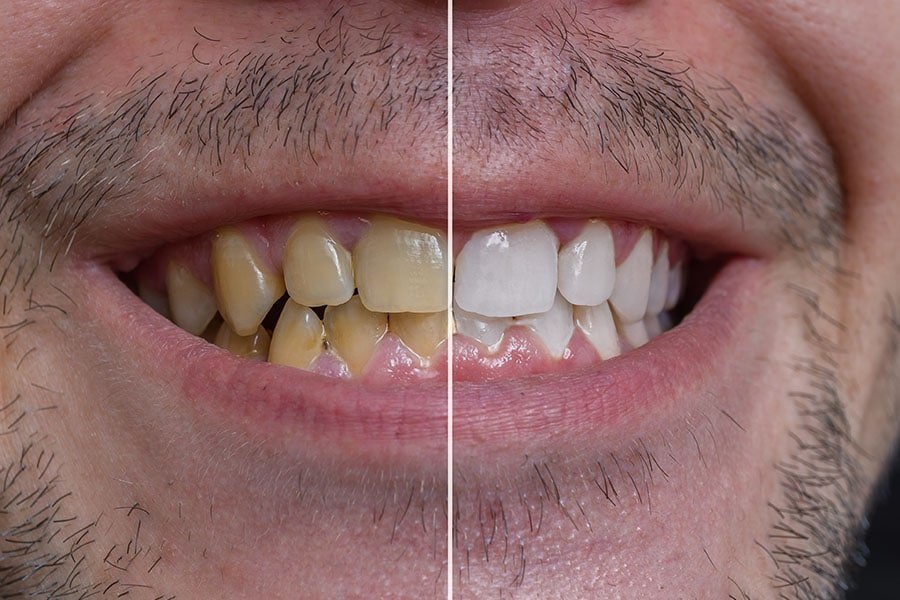 How to clean your teeth at home