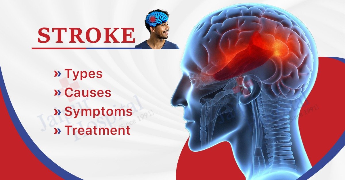 Want to know about stroke?? Here it is for you!!