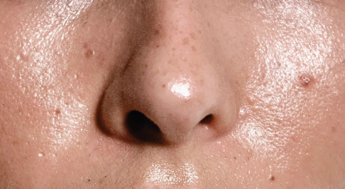 Is your face oily