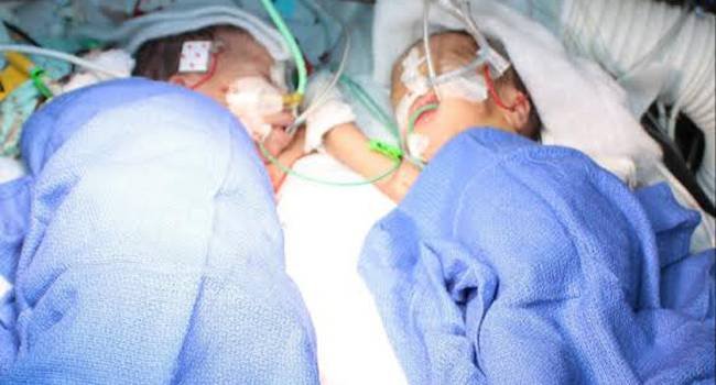 Peru conjoined twins separated surgery success 2025