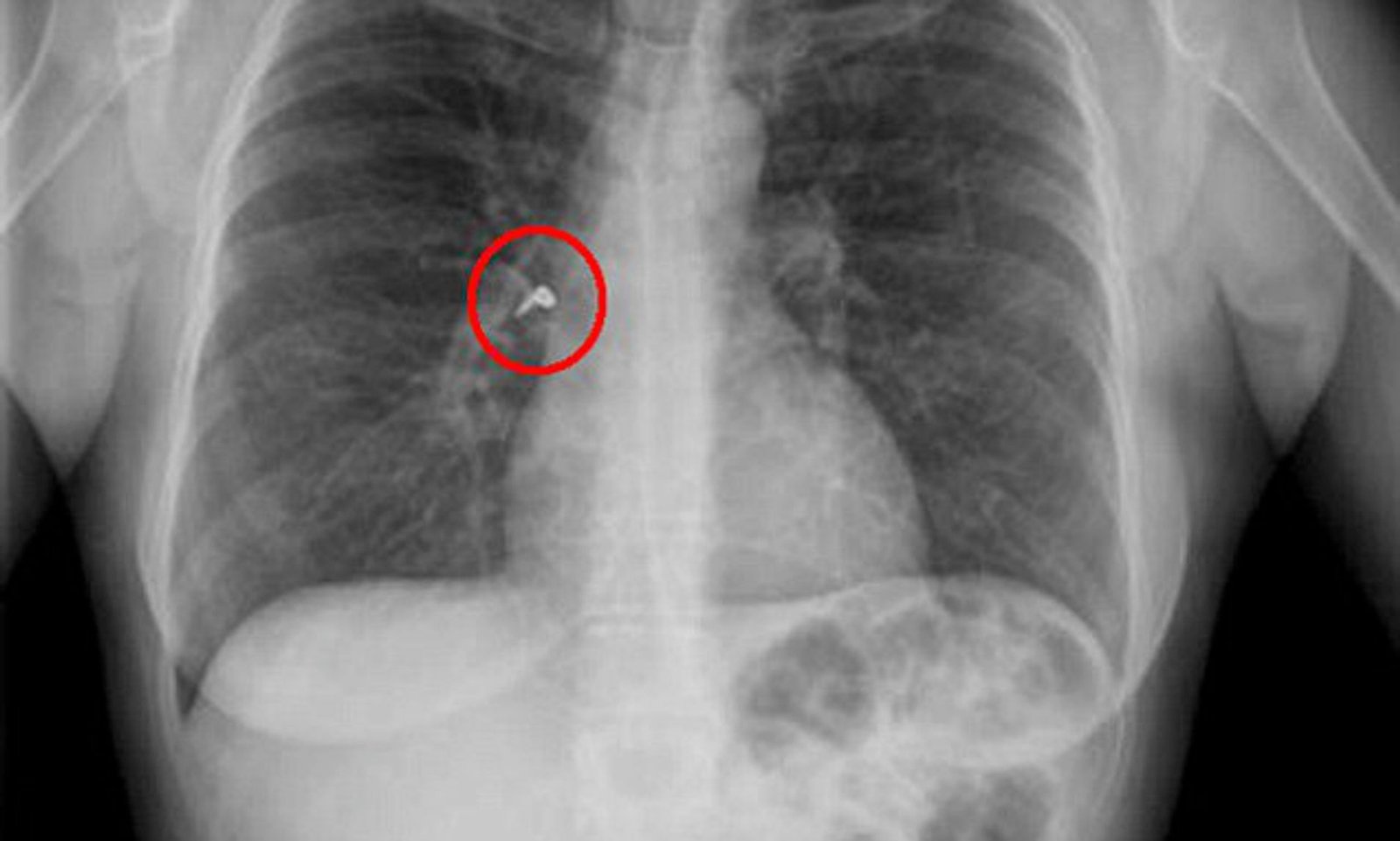 Medical Miracle, Bronchoscopy, Cuddalore Doctor, Gold Screw in Lung.